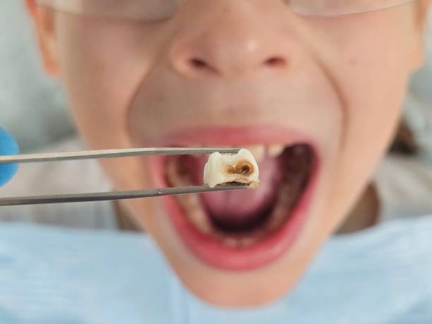 Best Knocked-Out Tooth (Avulsed Tooth) Treatment in Fall City, WA